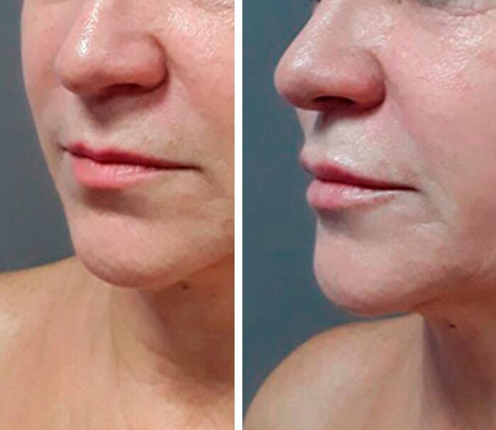 Фото до и после: Коррекция губ препаратом гиалуроновой кислоты
