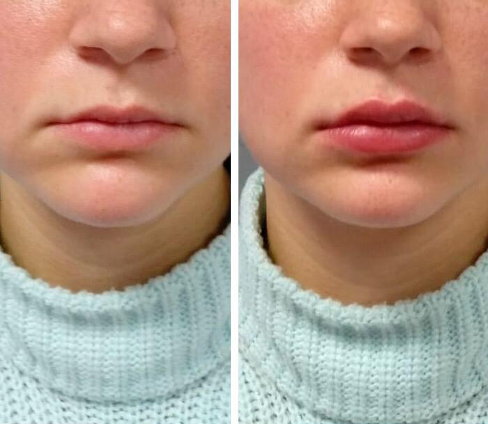 Фото до и после: Коррекция губ препаратом гиалуроновой кислоты