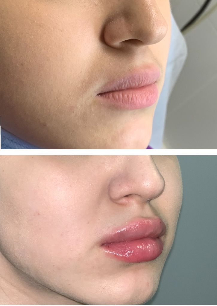 Фото до и после: Контурная пластика губ гиалуроновой кислотой